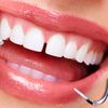Fechamento de Diastema com resina (espacinho entre dois dentes). valor para cada fechamento.