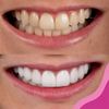 Clareamento Dentário