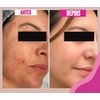 Peeling Químico