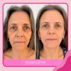 Skinbooster + Jato de Plasma