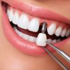Implante Dentário (valor de cada dente)