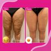 Lipedema e Celulite
