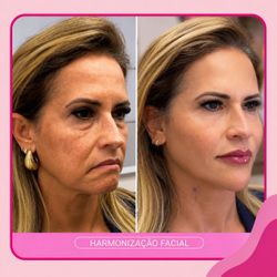 Harmonização Facial