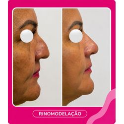 Rino-modelação 