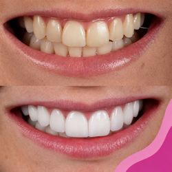 Clareamento Dentário