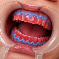 Clareamento dentário total de consultório. Arcadas Superior e Inferior. 2 sessões.