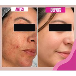 Peeling Químico