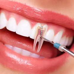 Endodontia, tratamento de canal (valor de cada dente)
