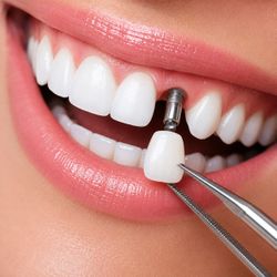 Implante Dentário (valor de cada dente)
