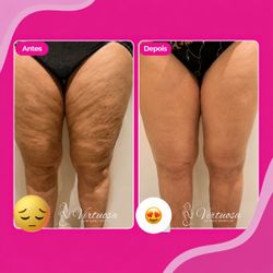 Lipedema e Celulite