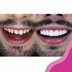 Facetas em Porcelana