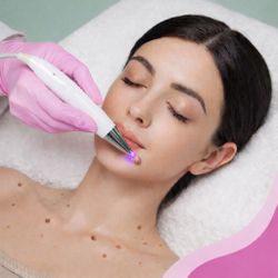 Remoção de Pintas e Verrugas - 1 sessão de uma hora + retorno