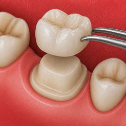 Coroa Dentária - metal free - por dente