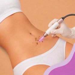 Remoção de Manchas - 4 sessões de jato de plasma (cada região)