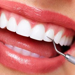 Limpeza com Ultrasson (retirada de tártaros em todos os dentes)