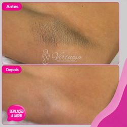 Depilação a Laser