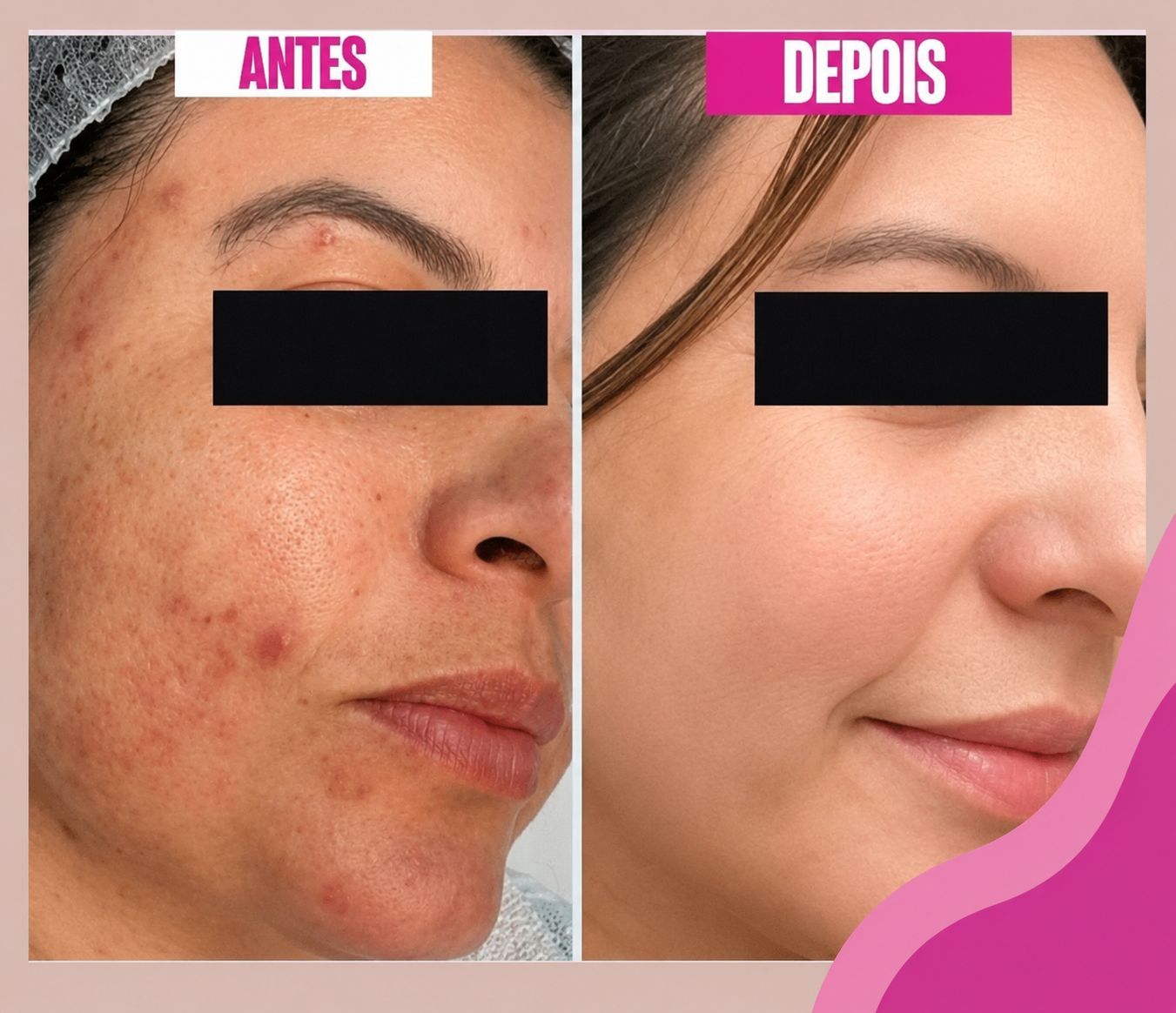 Peeling Químico