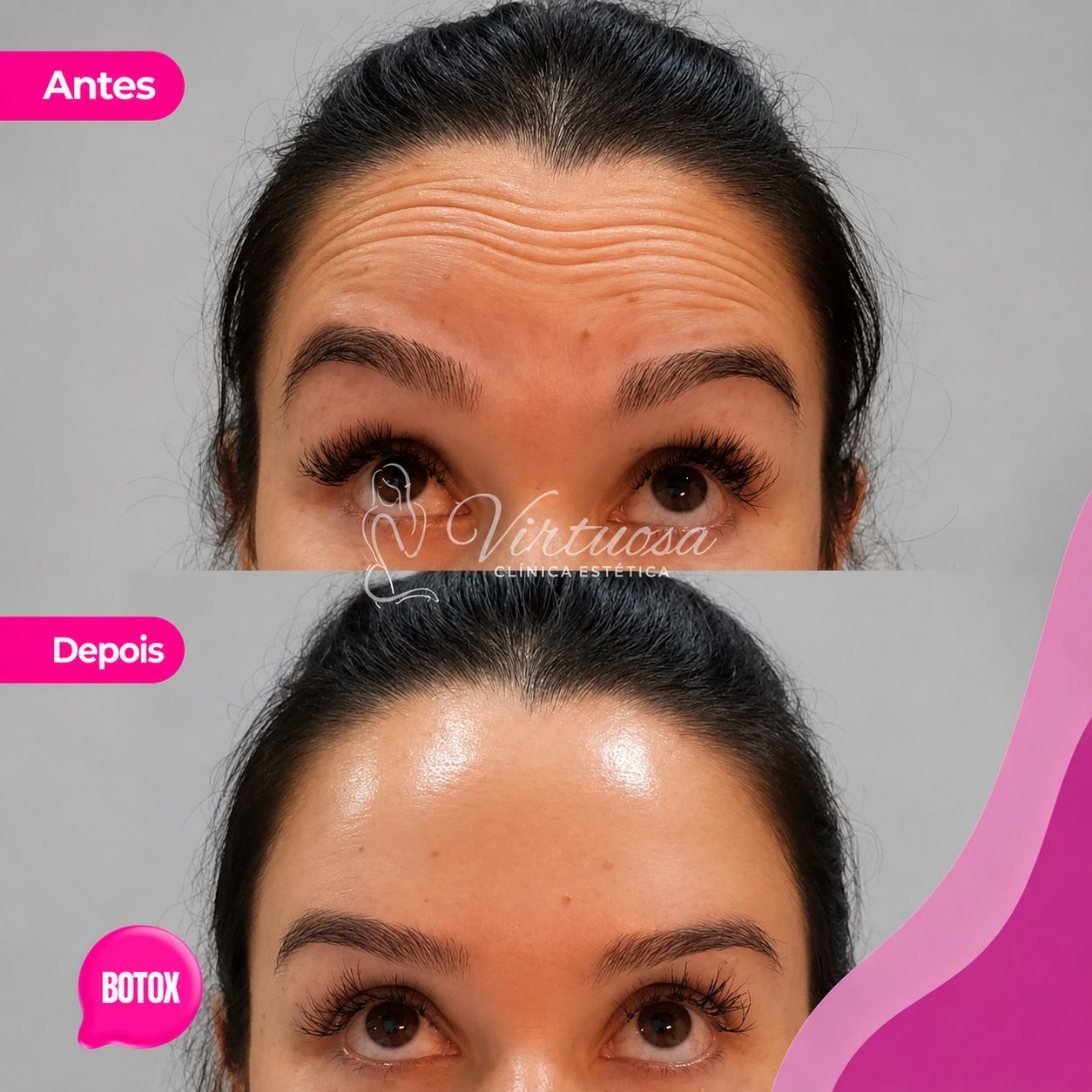 Botox