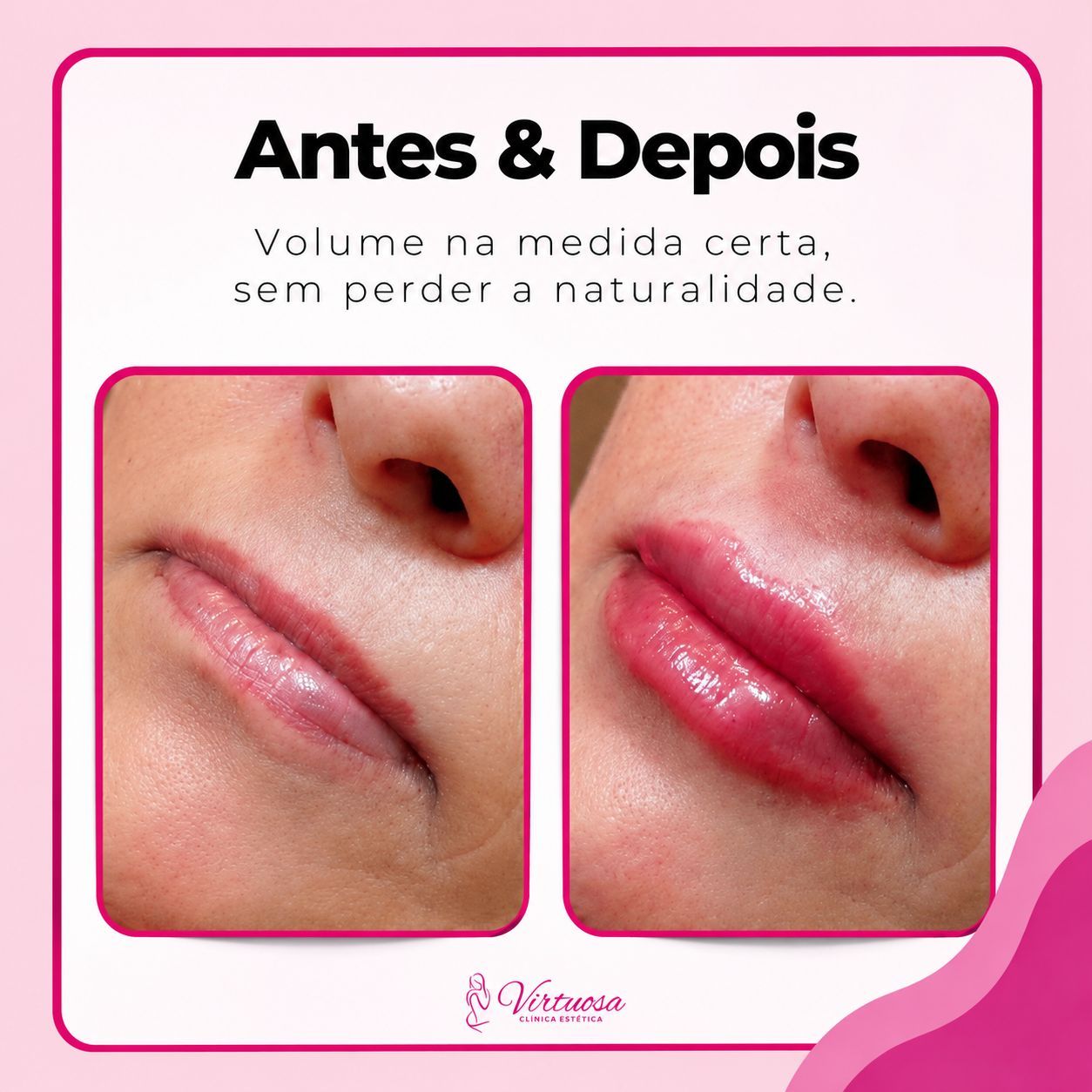 Prenchimento Labial