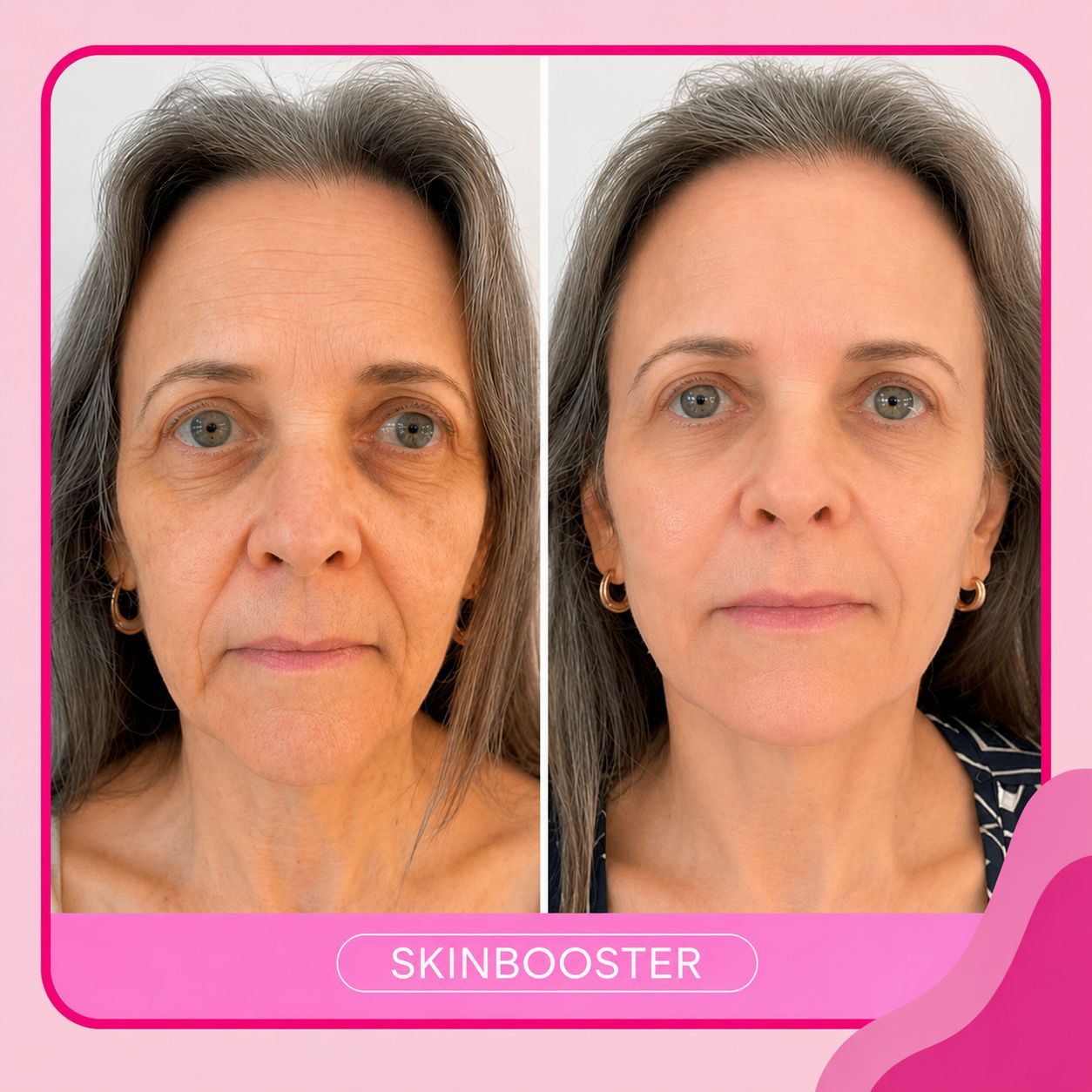 Skinbooster + Jato de Plasma
