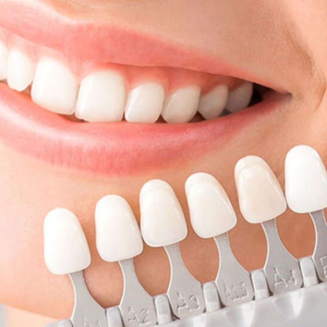 Facetas (lentes em porcelana) - Valor de cada dente