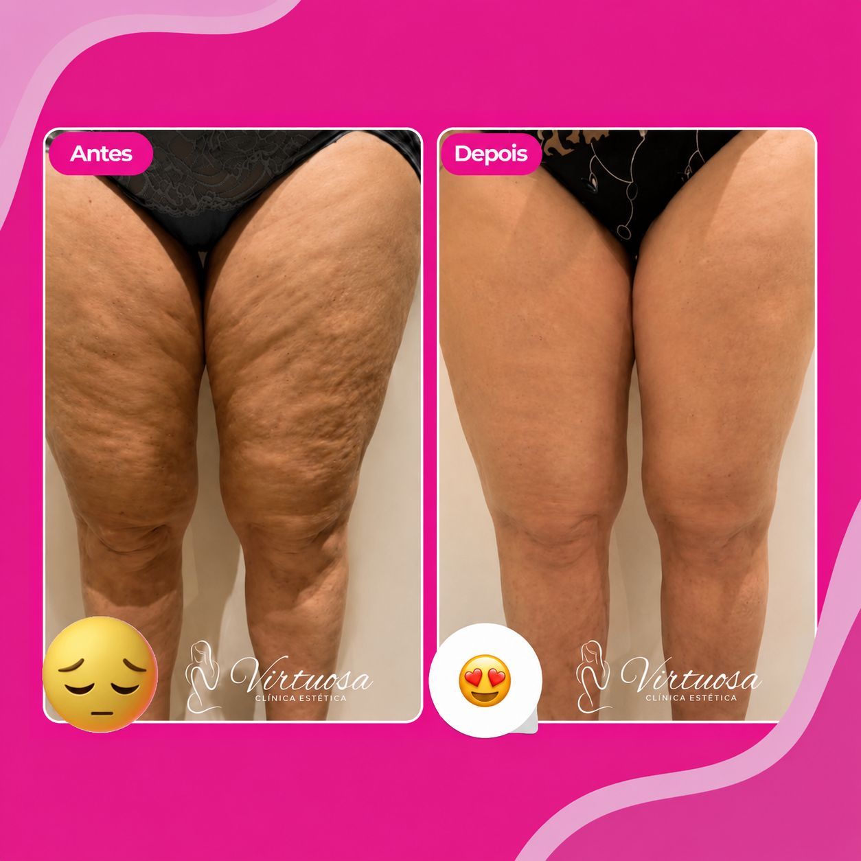 Lipedema e Celulite