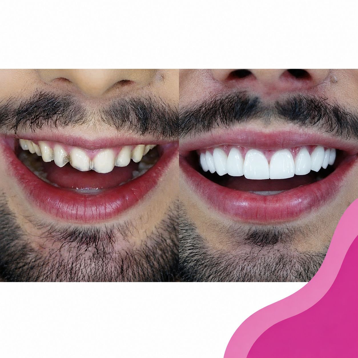 Facetas em Porcelana