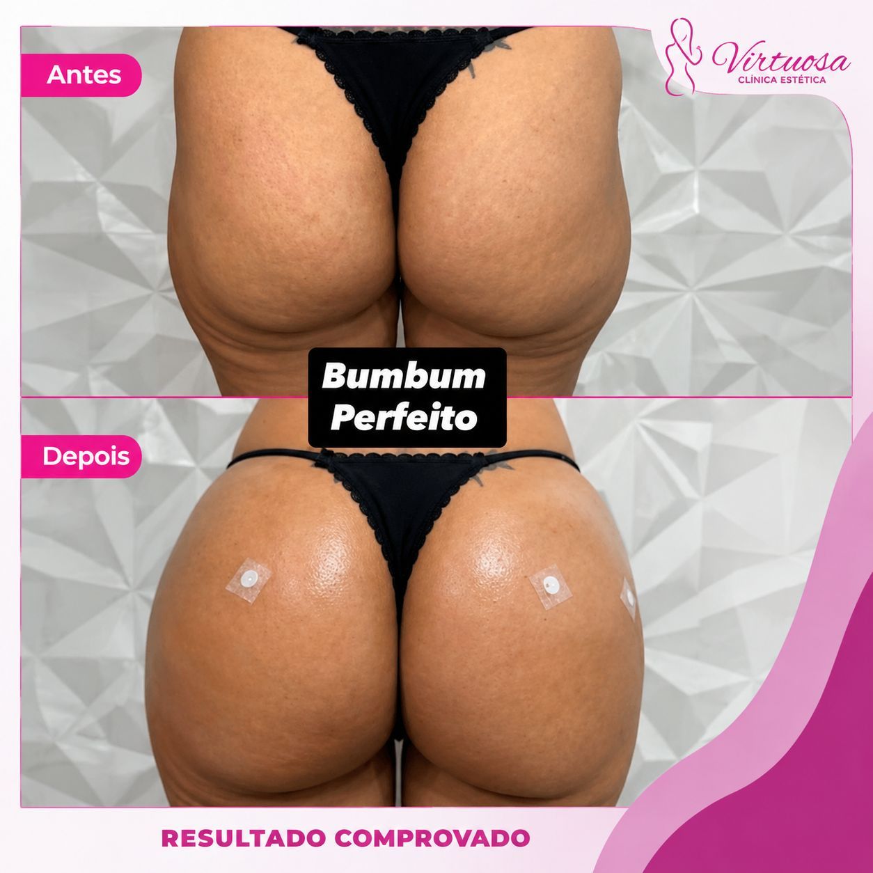 Hamonização Glúteos