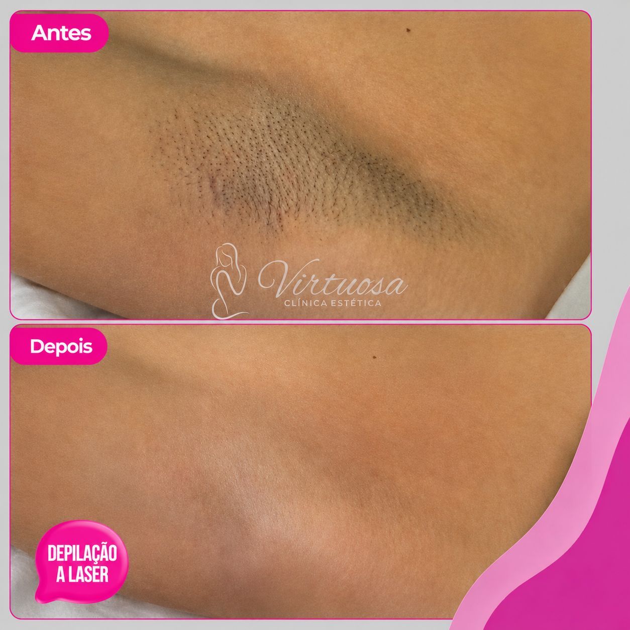 Depilação a Laser