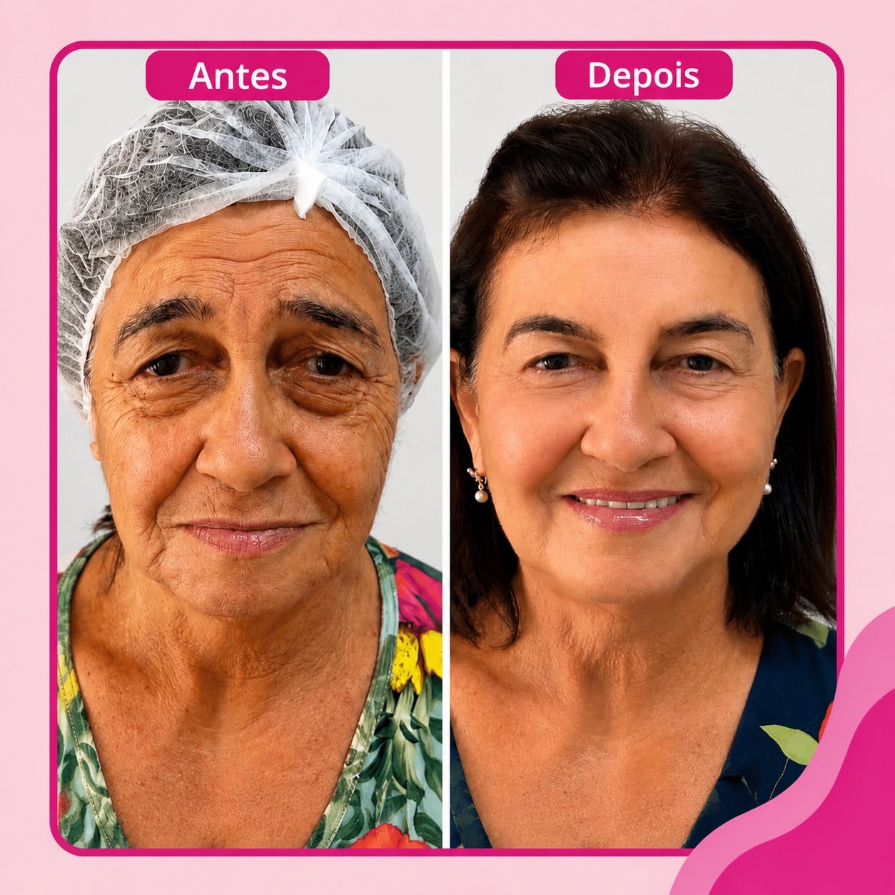 Bioestimulador de Colágeno